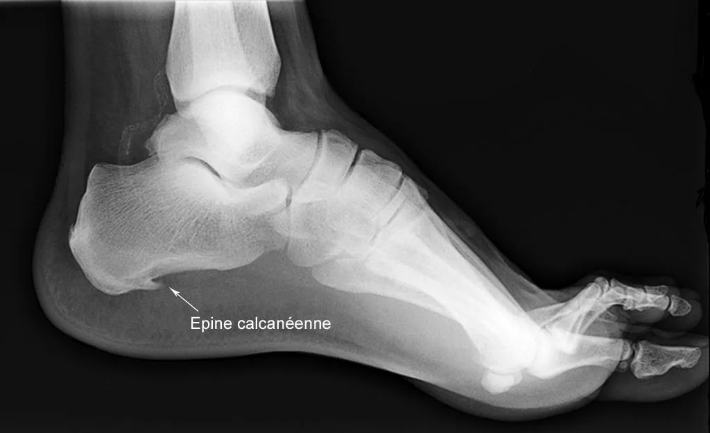 Radiographie épine calcanéenne